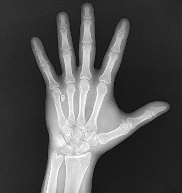 x-ray hand showing chip